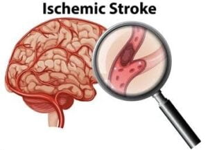Stroke Management 1 IMG 4751