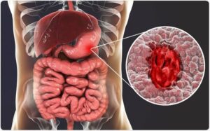 UNDERSTANDING PEPTIC ULCER DISEASE 1 IMG 6003