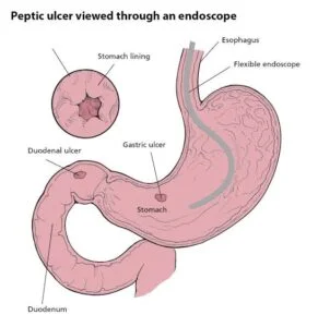Understanding Peptic Ulcer Disease 2 IMG 6021