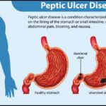 Understanding Peptic Ulcer Disease